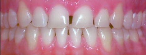 Crown lengthening before