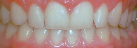 Gingival recontouring after