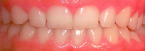 Gingival recontouring before