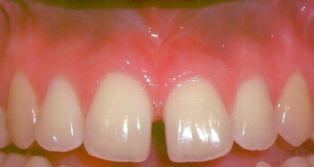 Frenectomy after
