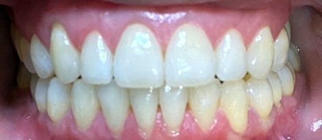 Yiran H after