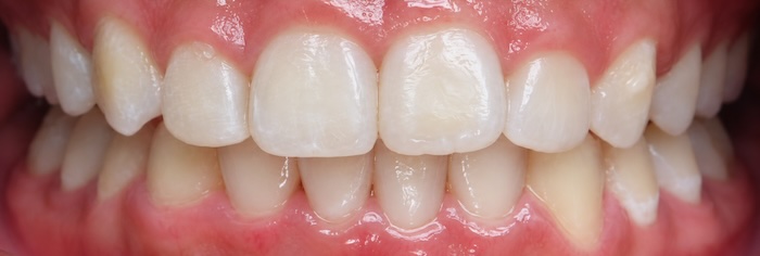 Invisalign after
