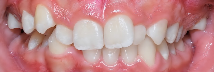 Invisalign before