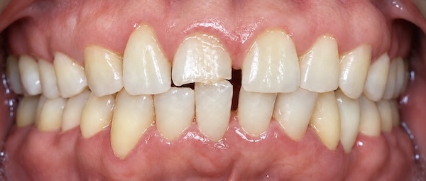 Tyrone Before
