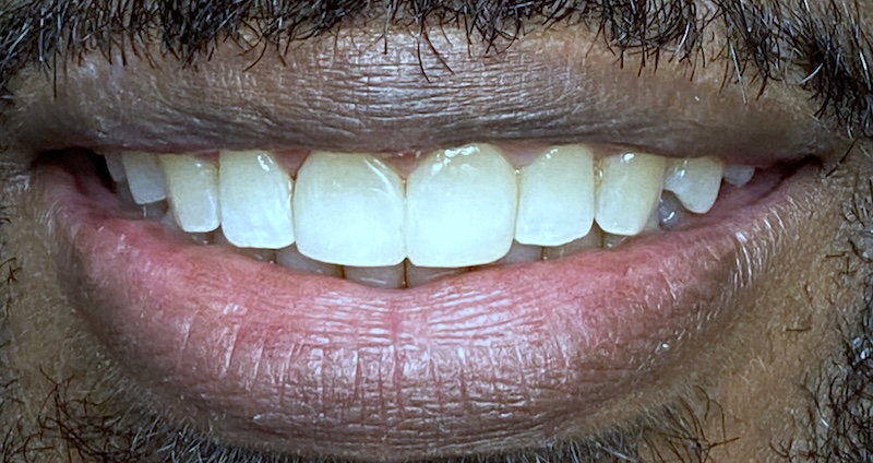 Tyrone after