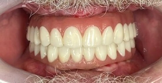 After Implants with Denture