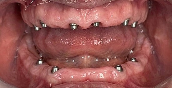 After Implants