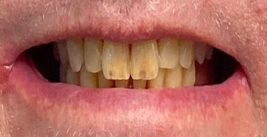 Before Implant
