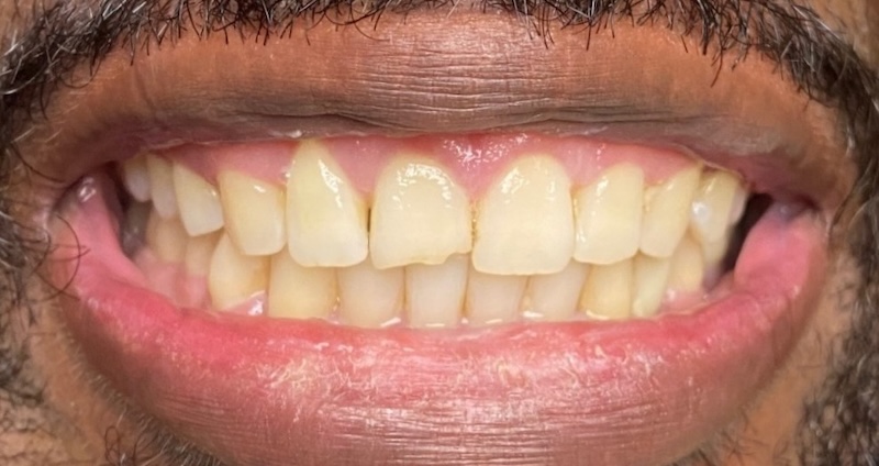Tyrone before