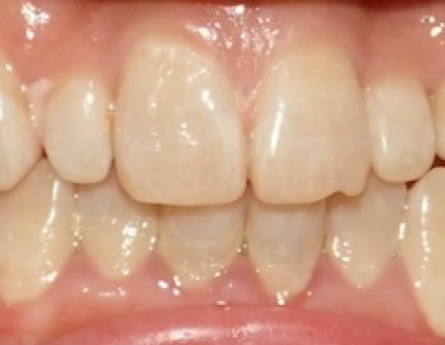 Calida C before