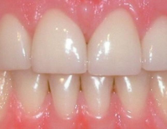 Crown lengthening after