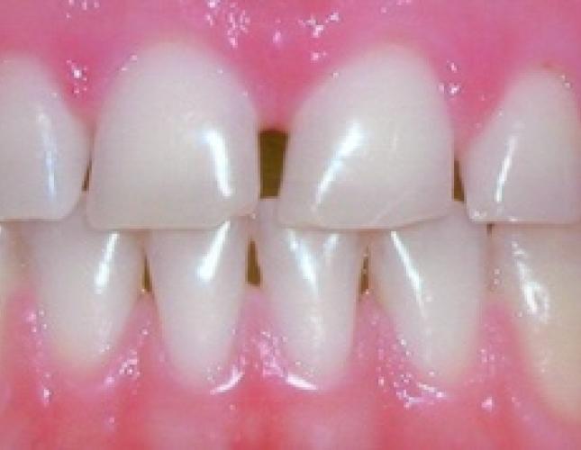Crown lengthening before