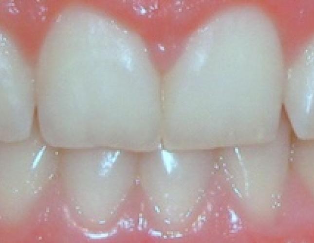 Gingival recontouring after