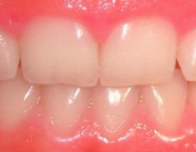 Gingival recontouring before