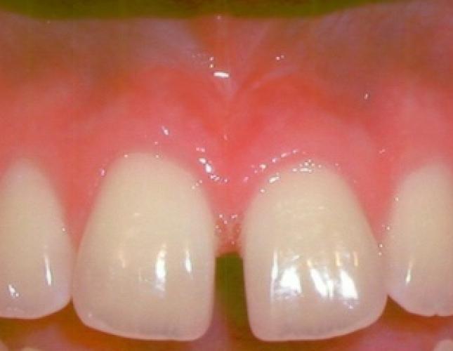 Frenectomy after