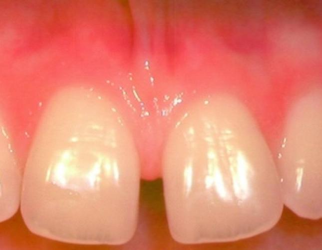 Frenectomy before
