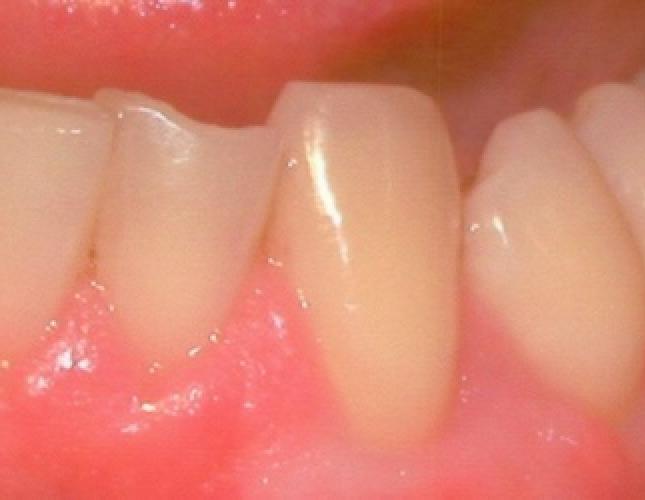 Soft tissue graft after 2