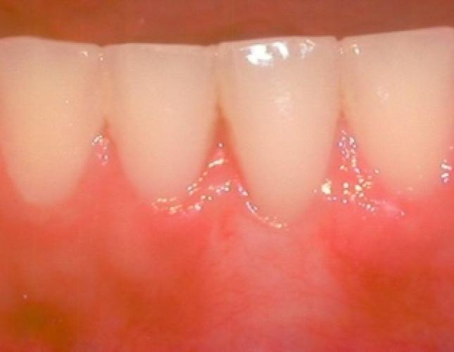 Soft tissue graft after 3