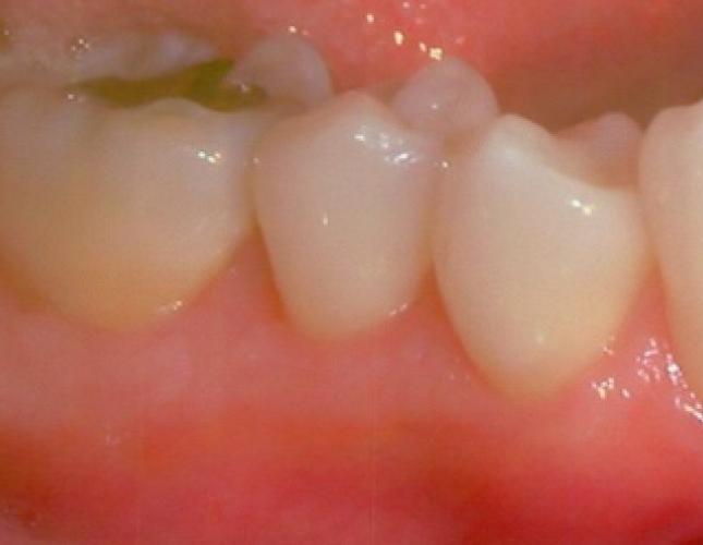Soft Tissue Grafting 4 after Soft Tissue Grafting 4 after