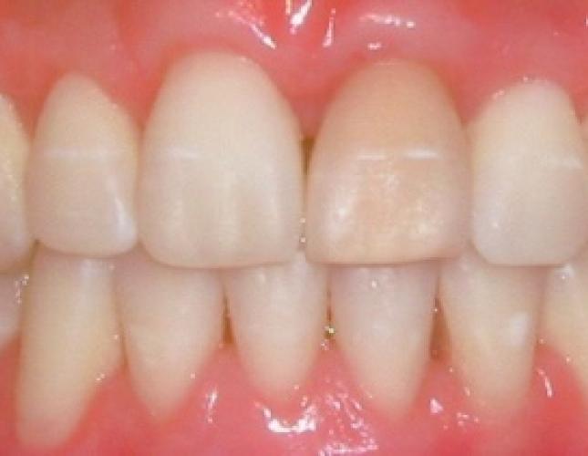 Soft Tissue Grafting 5 after