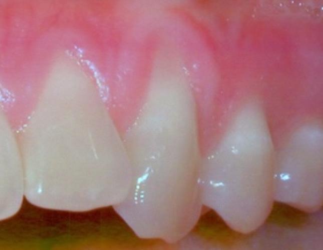 Soft tissue graft before
