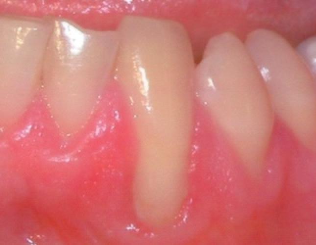 Soft tissue graft before 2