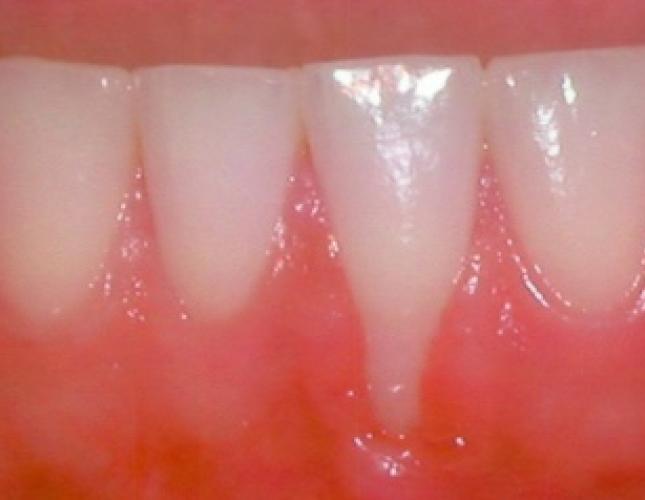 Soft tissue graft before 3