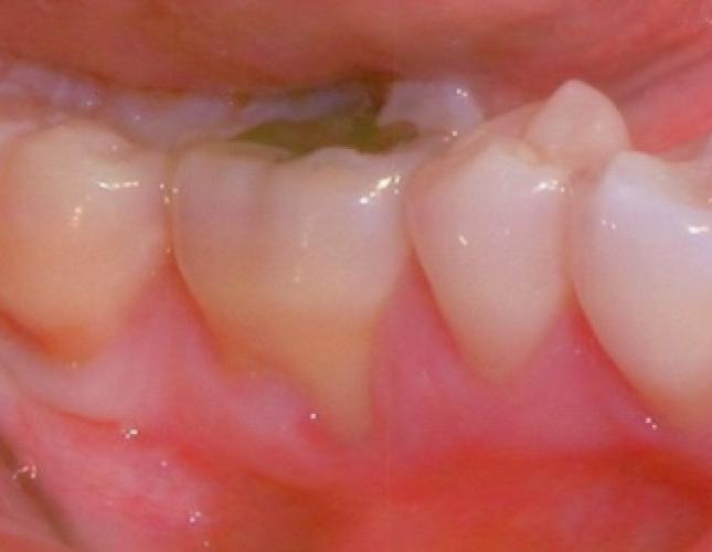 Soft Tissue Grafting 4 before Soft Tissue Grafting 4 before