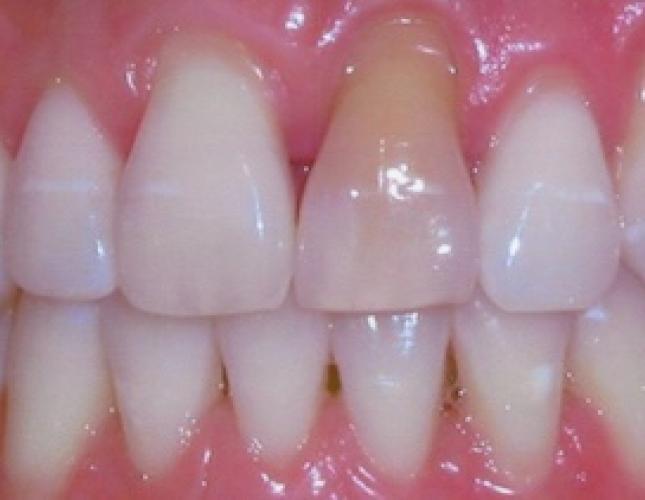 Soft Tissue Grafting 5 before