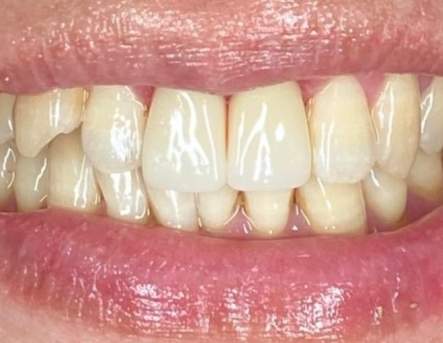 Crowns after