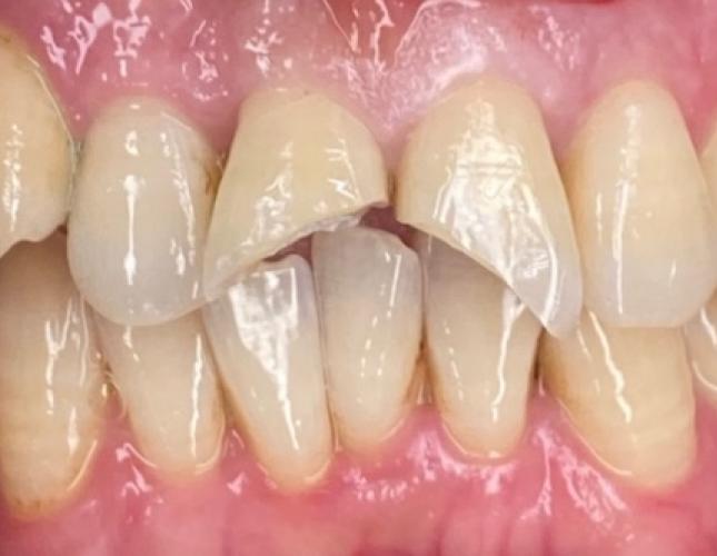Crowns before