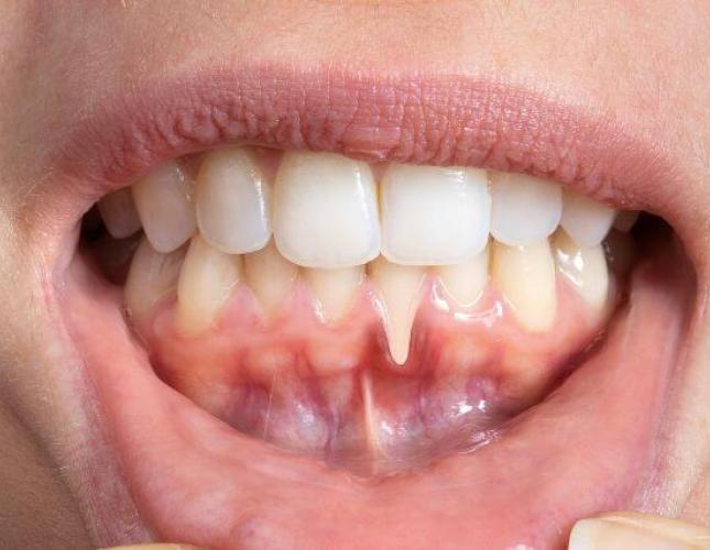 Gum Recession: Causes, Treatment, and Prevention